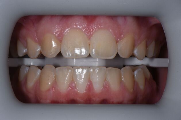 Teeth Whitening Case 1 - Before