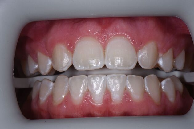 Teeth Whitening Case