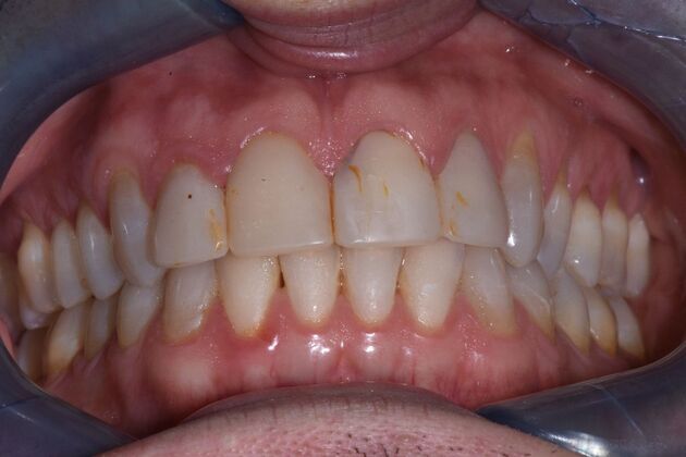 Veneers Case 1 - Before