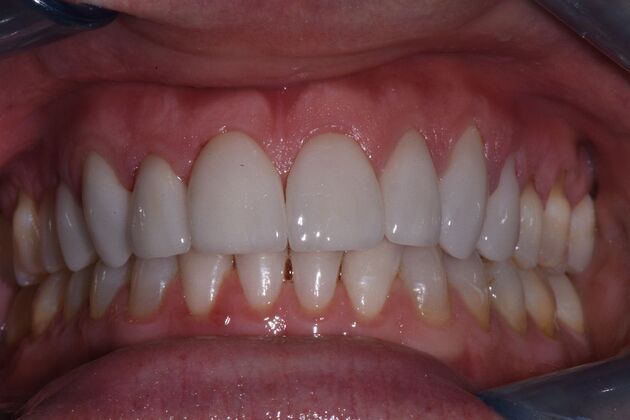Veneers Cases