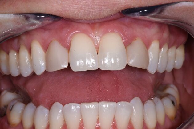 Veneers Case 2 - Before