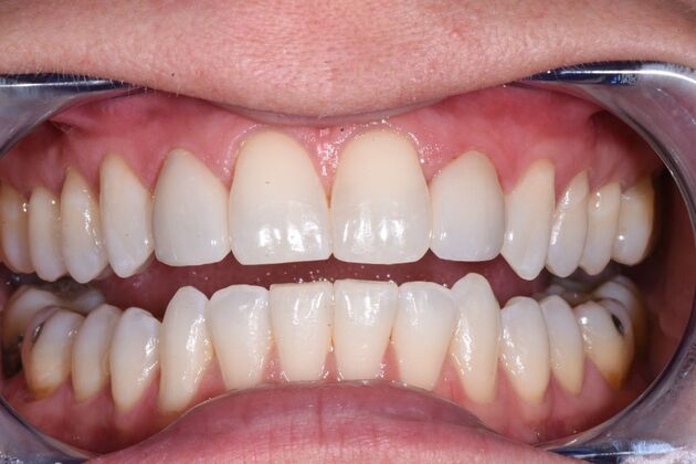 Veneers Case 2 - After