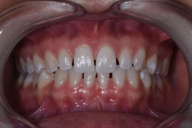 Veneers Case 3 - Before