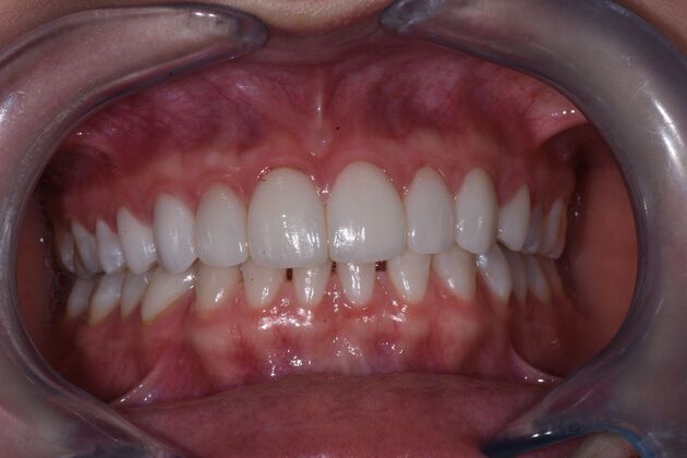 Veneers Case 3 - After