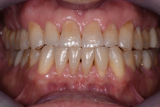 Veneers Case 4 - Before