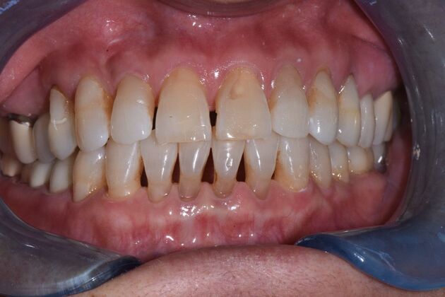 Veneers Case 5 - Before