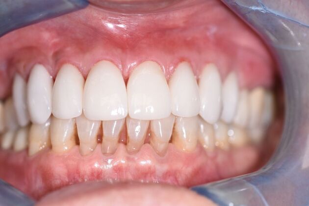 Veneers Case 5 - After