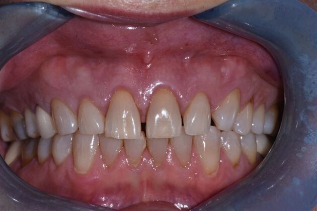 Veneers Case 6 - Before