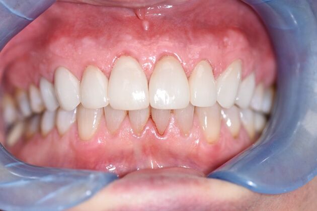 Veneers Case 6 - After