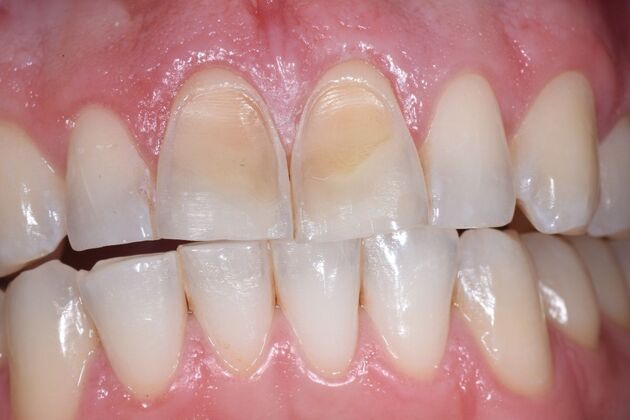 Veneers Case 7 - Before