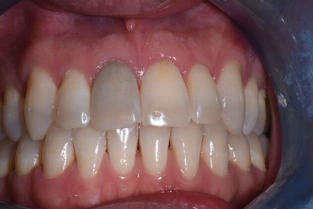 Veneers Case 8 - Before