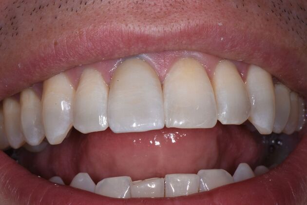 Veneers Case 8 - After