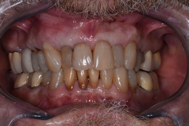 Invisalign + Dental Crowns Case 1 - Before