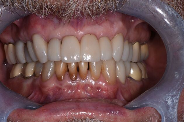 Invisalign + Dental Crowns Case