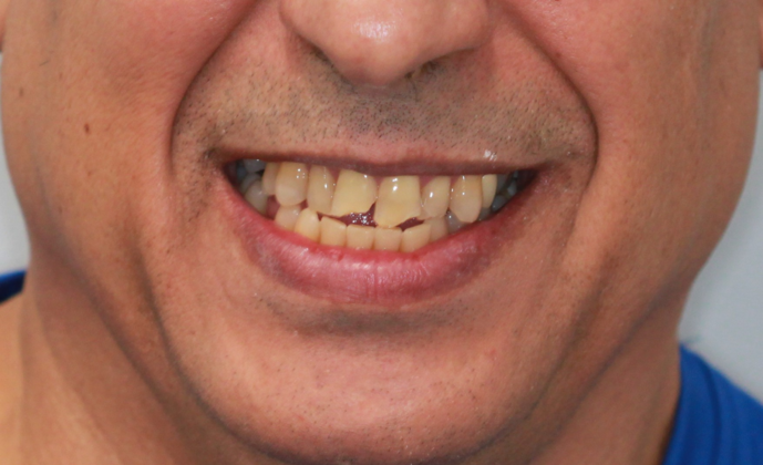 Porcelain Crowns and Veneers: Twelve Cosmetic Crowns to fix broken and crooked teeth - Before