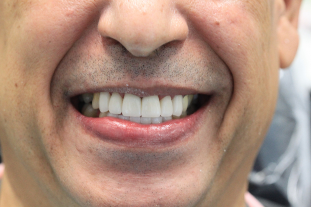 Porcelain Crowns and Veneers: Twelve Cosmetic Crowns to fix broken and crooked teeth - After