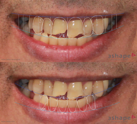 Porcelain Crowns and Veneers: Twelve Cosmetic Crowns to fix broken and crooked teeth - Before
