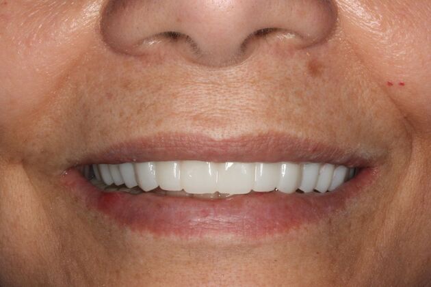 Dental Implants Cases