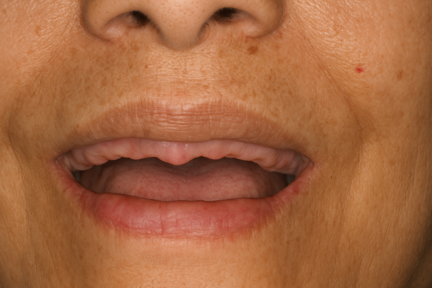 Dental Implants Maxillary (Upper) Hybrid Implant Bridge - Before