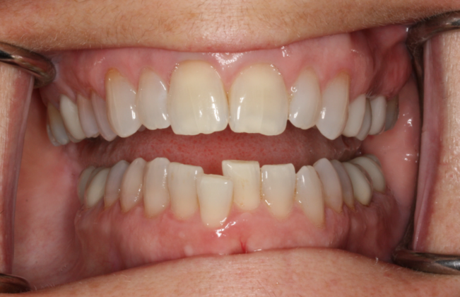 SureSmile Aligners (Compare to Invisalign) SureSmile Aligners Case 1 - Before