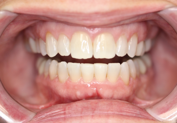 SureSmile Aligners (Compare to Invisalign) Case