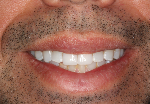 Porcelain Crowns and Veneers: Front Two Teeth Cosmetic Crowns - After