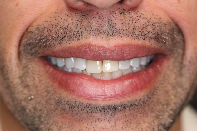 Porcelain Crowns and Veneers: Front Two Teeth Cosmetic Crowns - Before