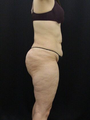 Liposuction: Case 56 - After