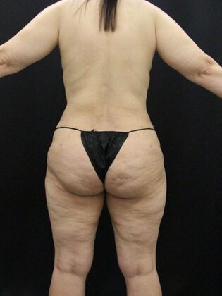 Liposuction Case 56 - After