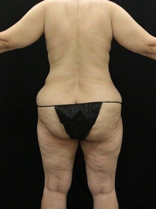 Liposuction Case 56 - Before