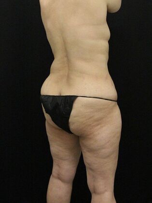 Liposuction: Case 56 - Before