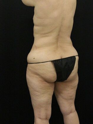 Liposuction: Case 56 - Before