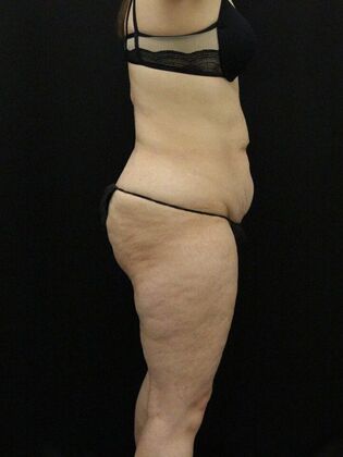 Liposuction: Case 56 - Before