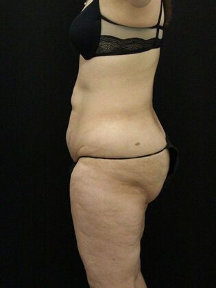 Liposuction: Case 56 - Before