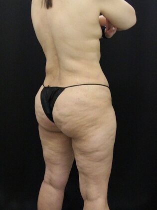 Liposuction: Case 56 - After