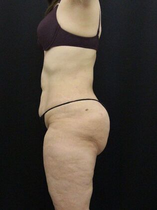 Liposuction: Case 56 - After