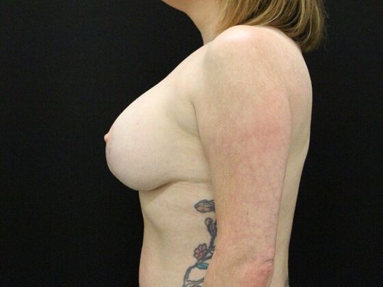Breast Lift & Breast Lift Augmentation: Case 36 - After