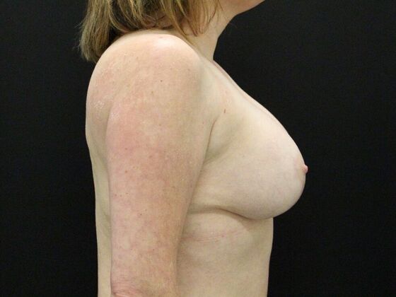 Breast Lift & Breast Lift Augmentation: Case 36 - After