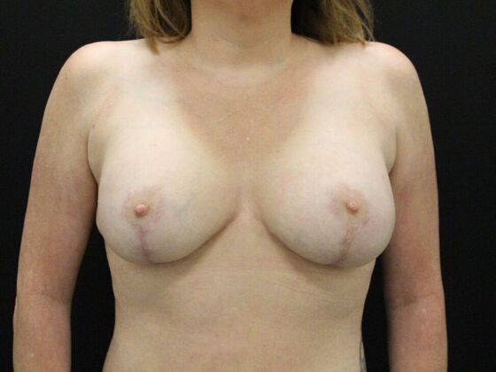 Breast Lift & Breast Lift Augmentation Case 36 - After