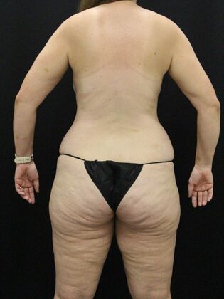 Tummy Tuck: Case 67 - Before