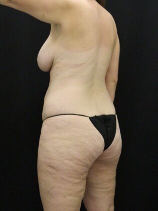 Tummy Tuck: Case 67 - Before