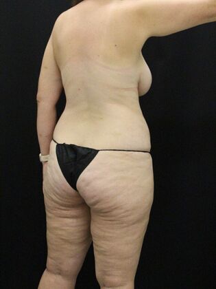 Tummy Tuck: Case 67 - Before