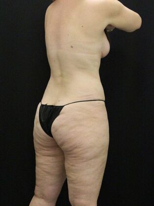 Tummy Tuck: Case 67 - After