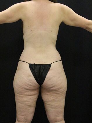 Tummy Tuck: Case 67 - After