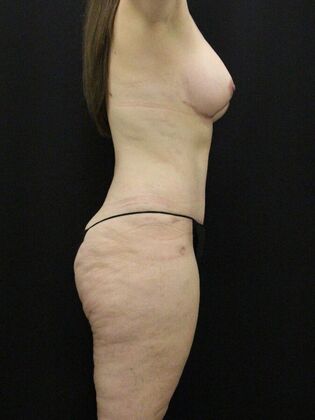 Tummy Tuck: Case 67 - After