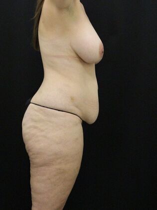 Tummy Tuck: Case 67 - Before