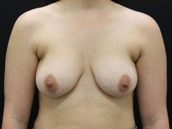 Breast Lift/Breast Lift Augmentation Case 65 - Before