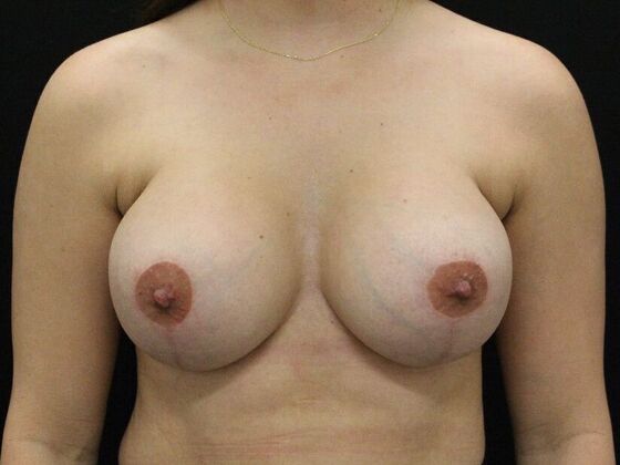Breast Lift/Breast Lift Augmentation Case 65 - After