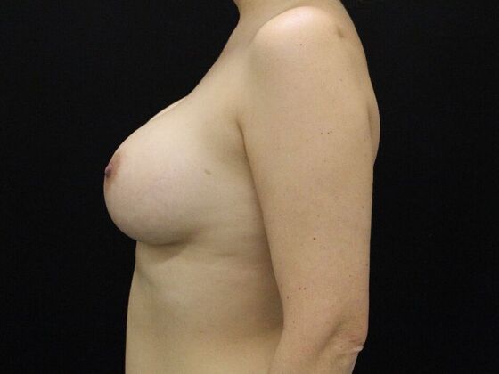 Breast Augmentation: Case 120 - After