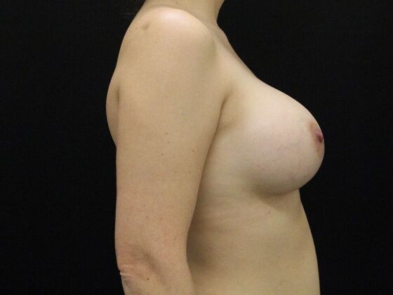 Breast Augmentation: Case 120 - After